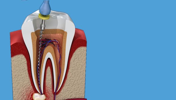What Is Root Canal Treatment?