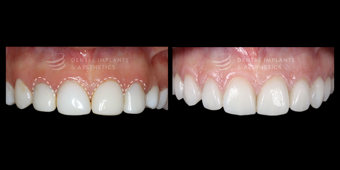 crown lengthening before and after at dental implants & aesthetics