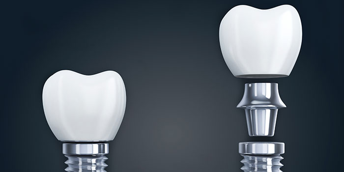 dental implants components fixture abutment implant crown