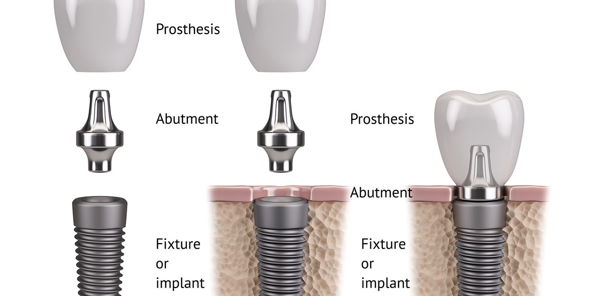 dental implants components