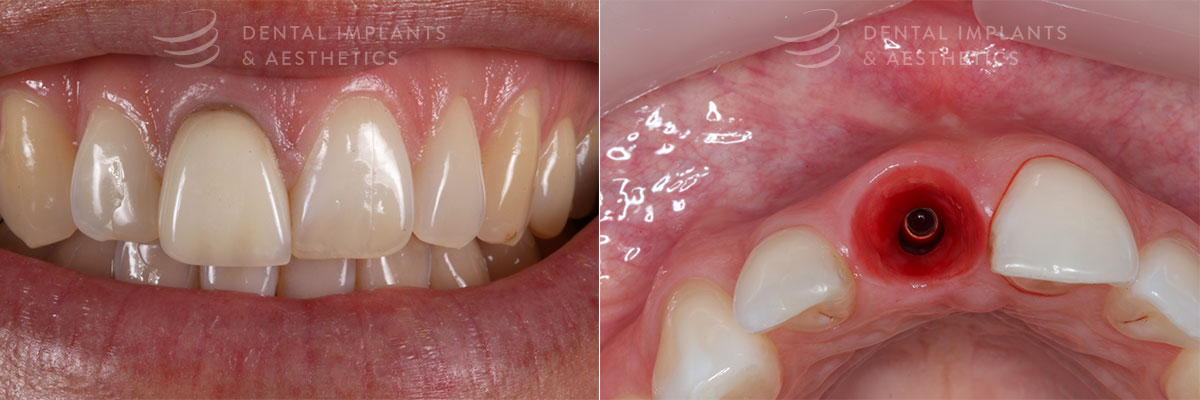 same-day dental implant placement before photos