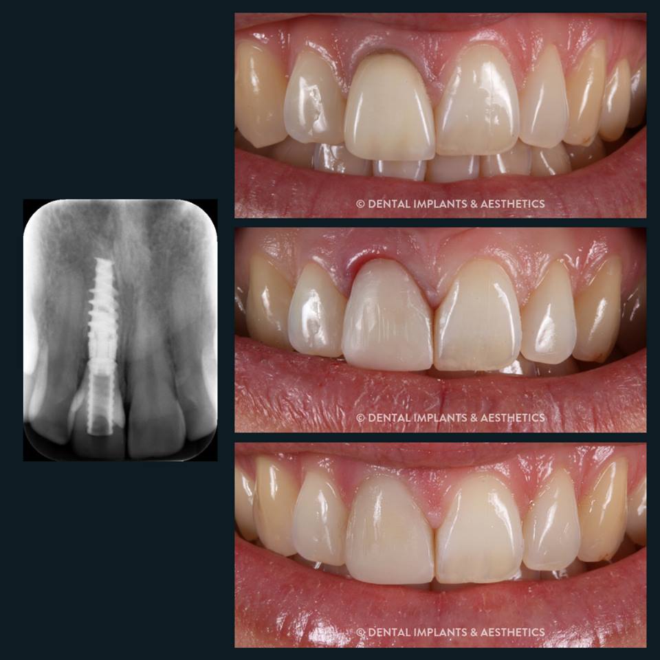 Dental Implants and Aesthics Case 2