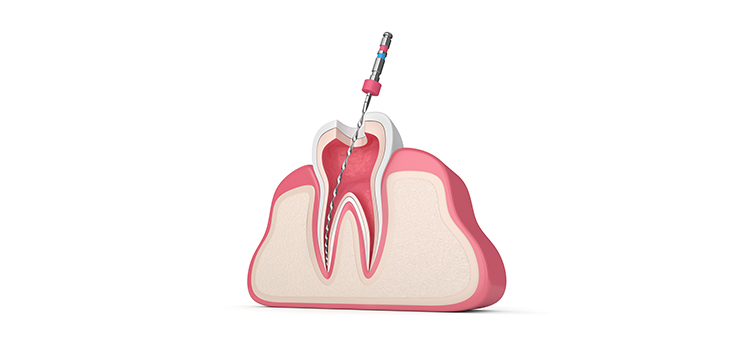 Root_Canal_treatment_diagram