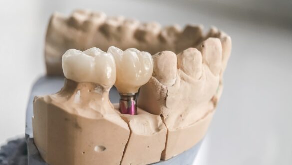 Posterior Dental Implants