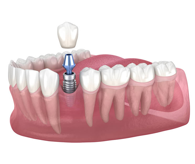 Single Tooth Dental Implant