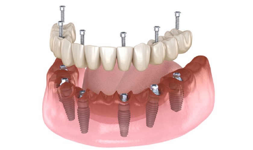 all-on-x-dental-implants