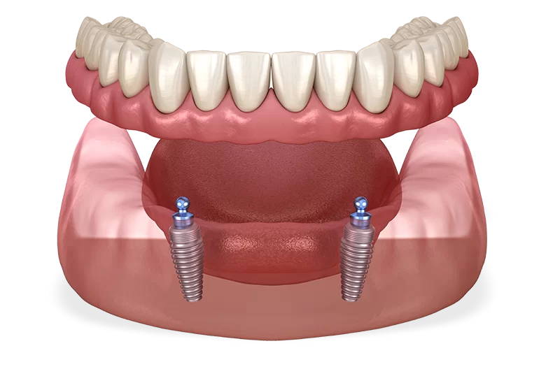 implant-retained-dentures