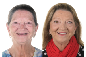 Betty's Full Mouth Rehabilitation Journey