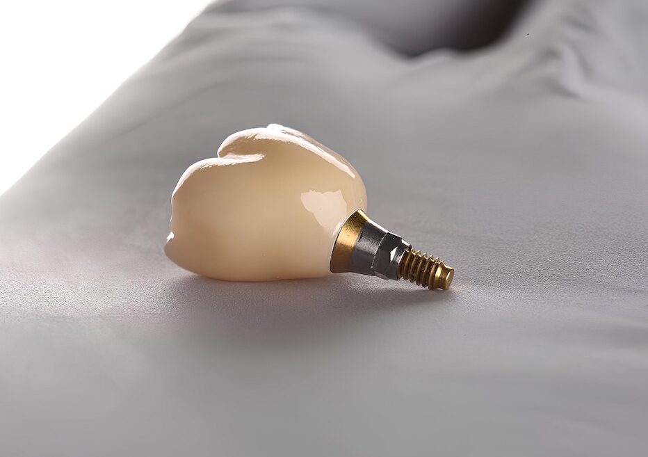 Complete Guide to Dental Implants