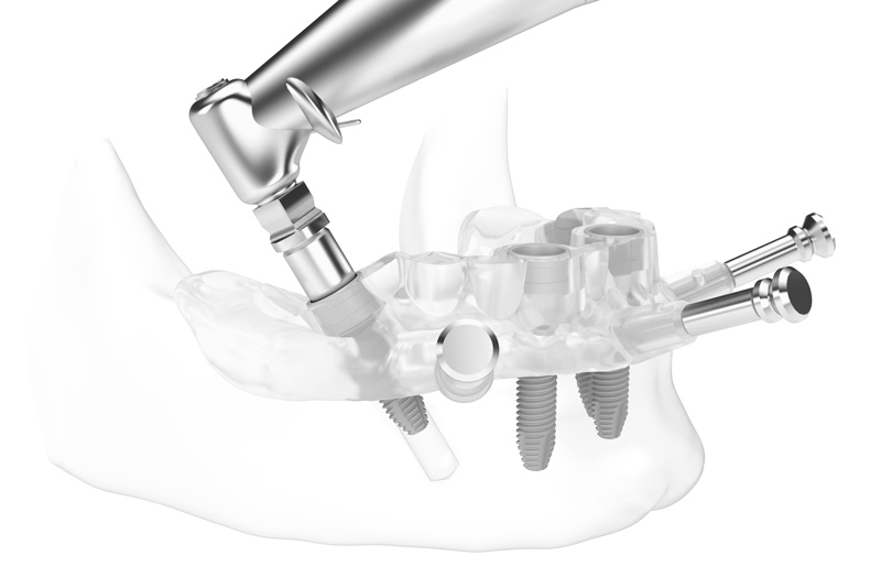 Guided Implant Surgery