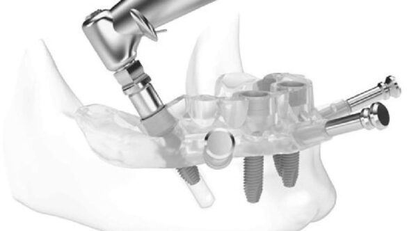 What Is Guided Implant Surgery?