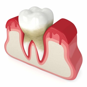 Periodontal Treatment