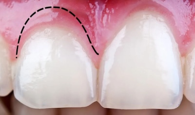 crown-lengthening