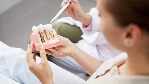 Replacing Missing Teeth: Dental Implants vs Bridges