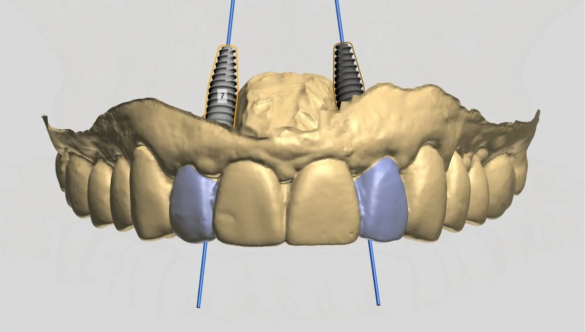 How 3D Planning Improves Dental Implant Outcomes