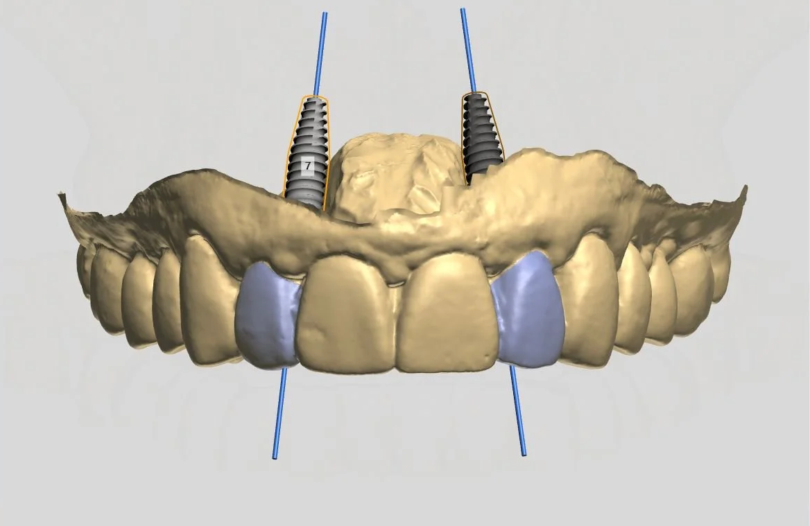 How 3D Planning Improves Dental Implant Outcomes
