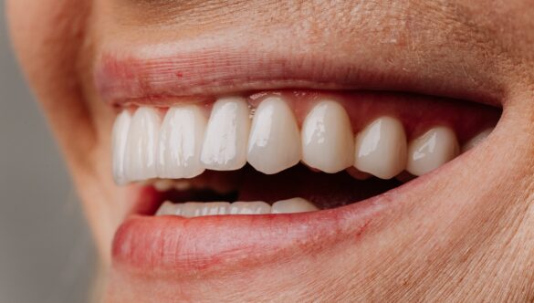 Composite Veneers vs Porcelain