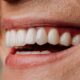 Composite Veneers vs Porcelain