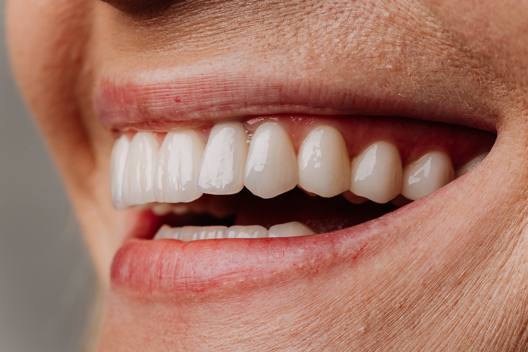 

Composite Veneers vs Porcelain Veneers